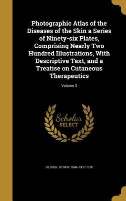 Download Photographic Atlas of the Diseases of the Skin a Series of Ninety-Six Plates, Comprising Nearly Two Hundred Illustrations, with Descriptive Text, and a Treatise on Cutaneous Therapeutics; Volume 3 - George Henry Fox | PDF